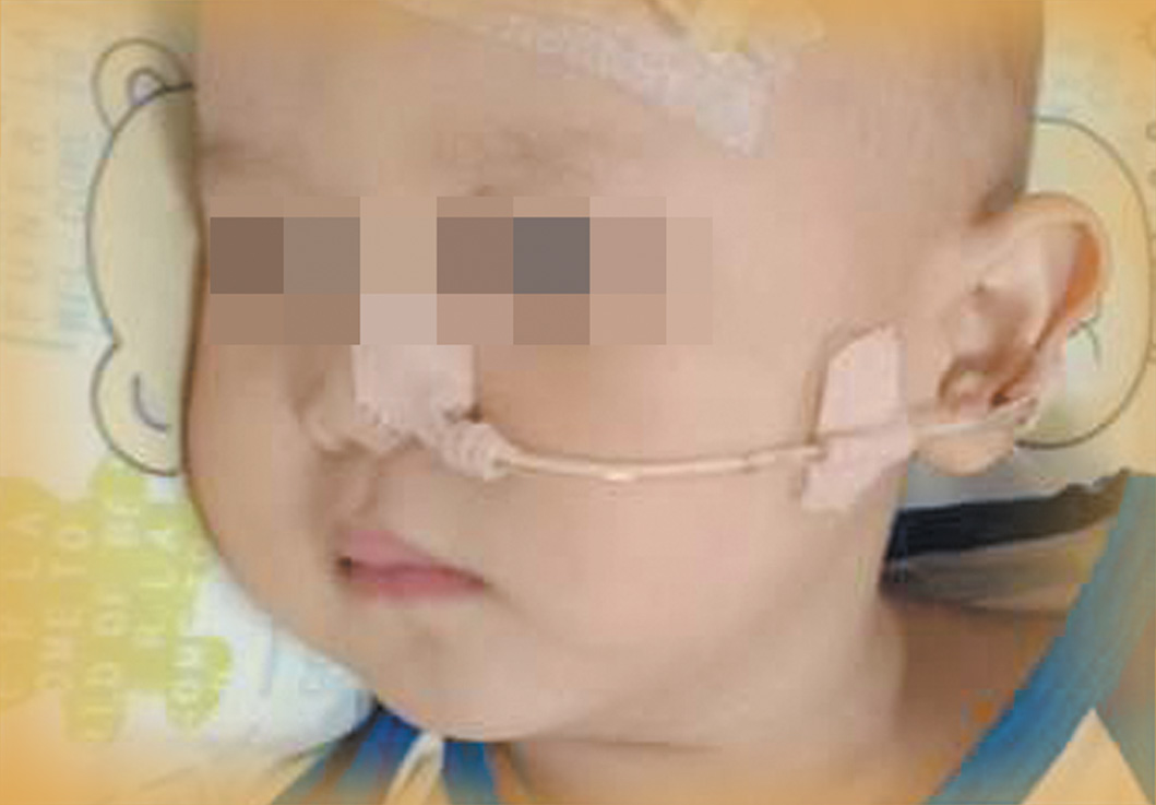 一岁男童误含电池爆炸